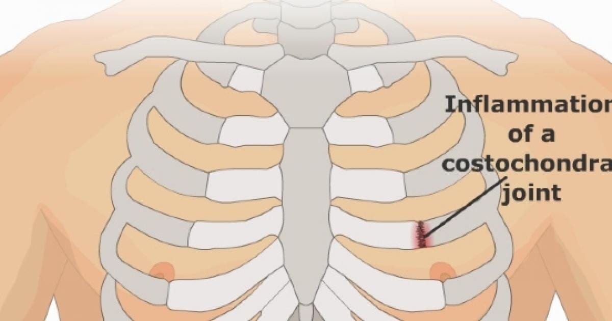 Costochondritis kan orsaka smärta i armhålan.